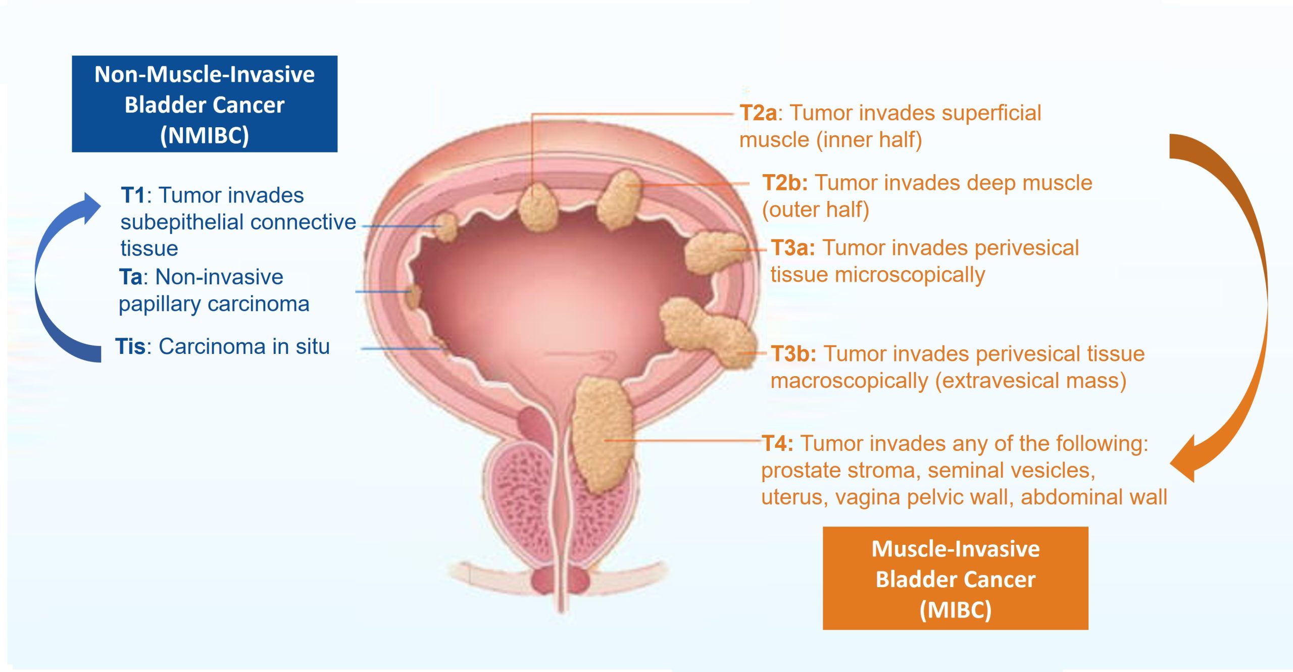 Bladder cancer progression: NMIBC & MIBC